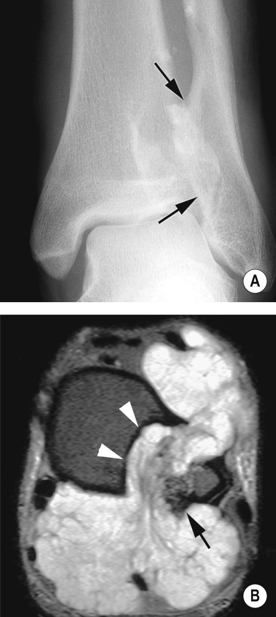 Peripheral chondrosarcoma. (A) AP XR showing an osteochondroma of the distal fibula (arrows). (B) Axial fat-suppressed T2WI shows a large malignant cartilage cap surrounding the osteochondroma (arrow) and causing pressure erosion of the adjacent tibia (arrowheads). *