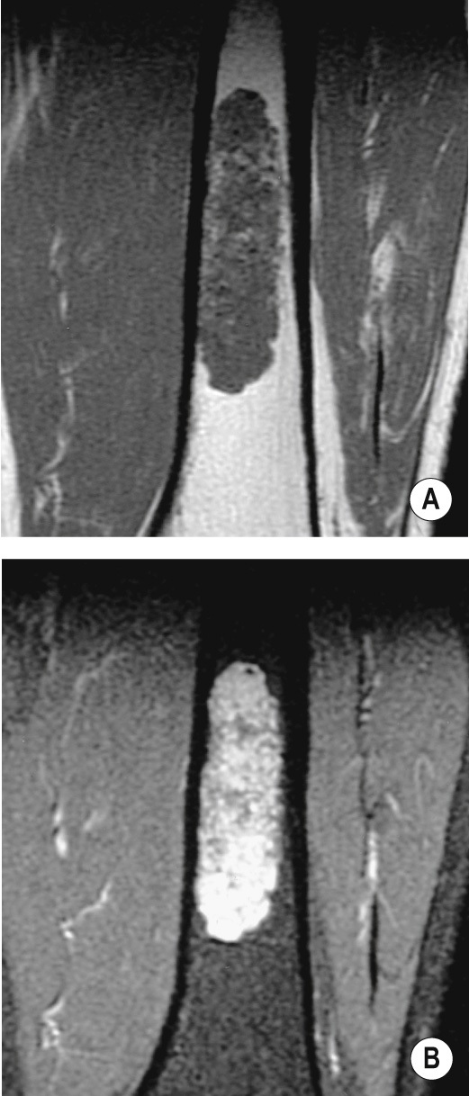 Chondrosarcoma of the femur. (A) Coronal T1WI and (B) STIR image show a large lobulated intramedullary lesion, which is particularly hyperintense on STIR. *