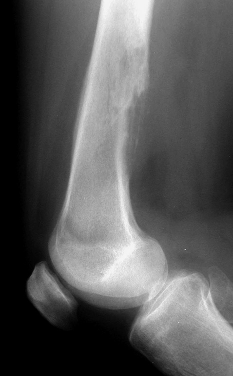 Lytic osteosarcoma. Lateral XR of the distal femur showing a lytic osteosarcoma. *