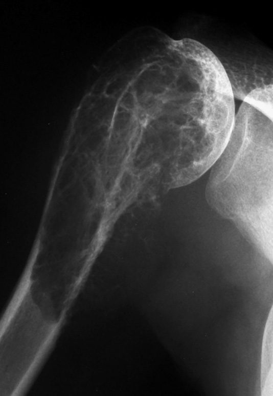 Low-grade central osteosarcoma. AP XR of the proximal humerus showing the lytic, trabeculated pattern. *