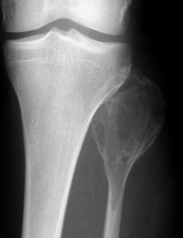 Pseudocystic osteosarcoma. AP XR of the proximal fibula showing an expanded, lytic lesion mimicking an aneurysmal bone cyst. *