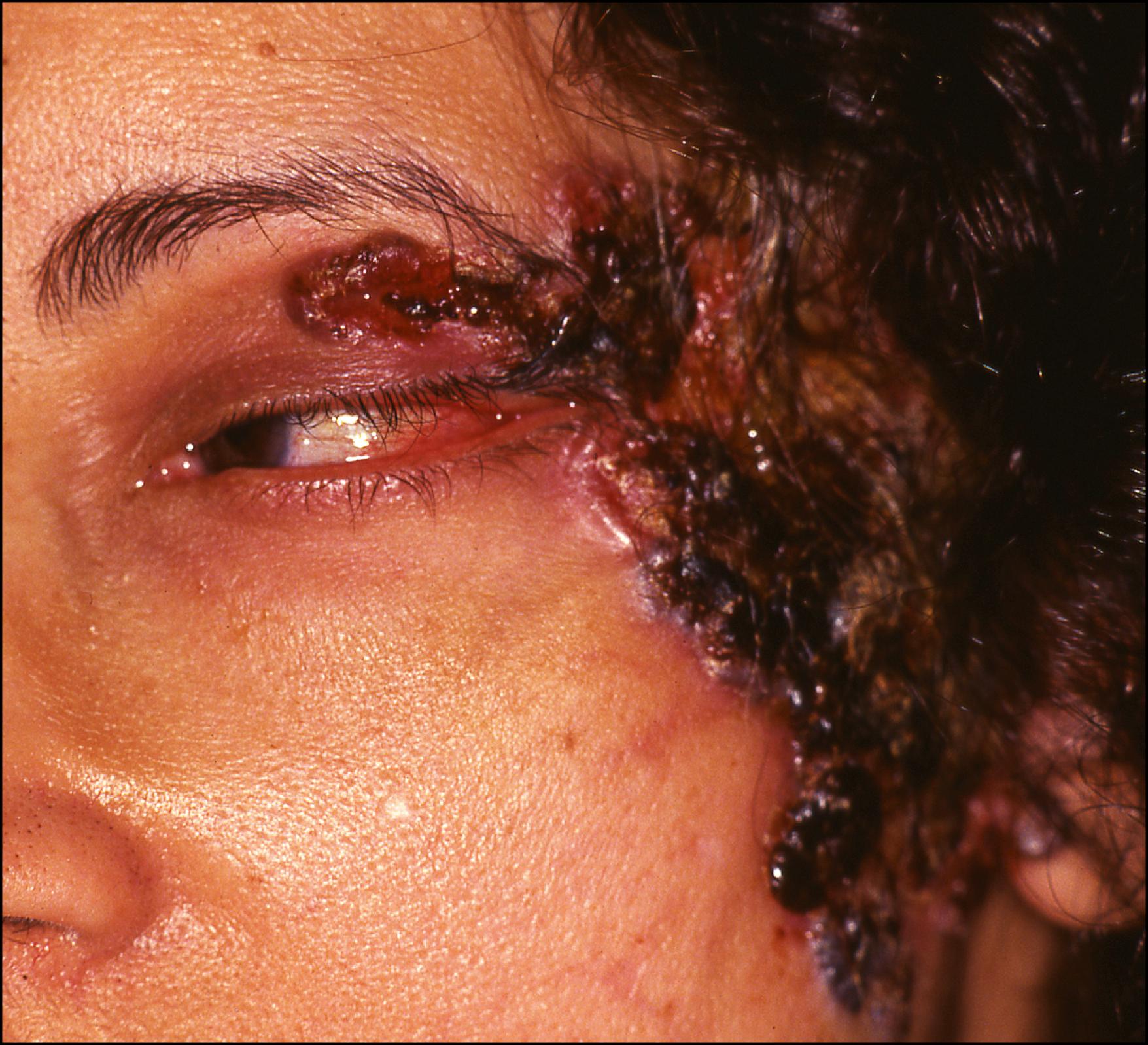 Fig. 28.3, An extensive field-fire lesion involving the eyelids, temple, cheek, and preauricular regions.