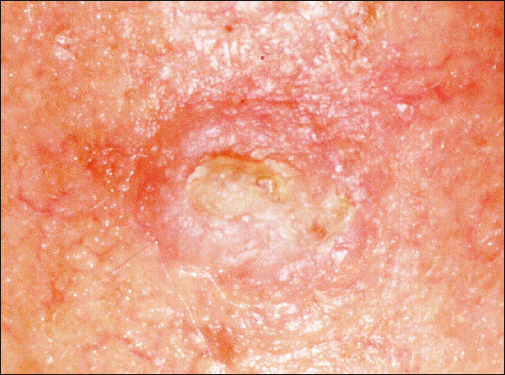 Fig. 28.5, An actinic keratosis on dorsum of nose. A round, flat, scaly keratotic plaque with an erythematous base.