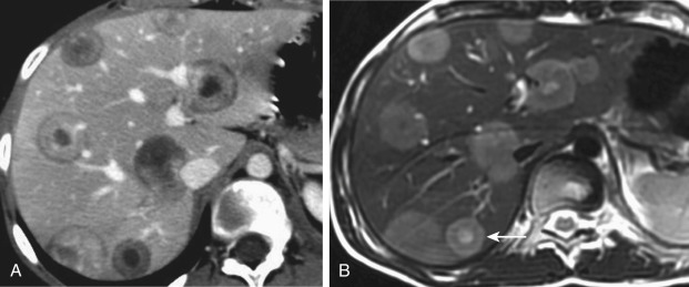 Figure 37-1, Typical computed tomography (CT) and magnetic resonance imaging (MRI) findings of epithelioid hemangioendothelioma. A, Transverse contrast-enhanced CT image during portal venous phase shows multiple round masses with a typical target appearance resulting from a hypoattenuating center surrounded by a hyperattenuating inner rim and a thin hypoattenuating outer halo. B, On this T2-weighted turbo spin echo MR image, the central area appears markedly hyperintense compared with the adjacent liver and is surrounded by a mildly hyperintense rim (arrow) that corresponds to viable tumor.