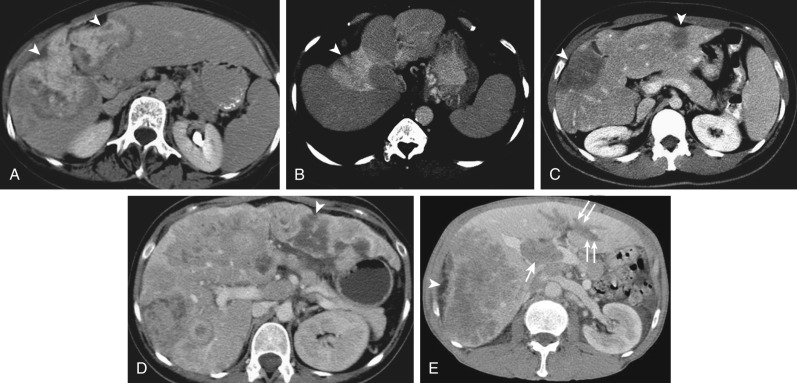 Figure 37-2, Computed tomography imaging findings and differential diagnosis among liver lesions associated with capsular retraction, including peripheral cholangiocarcinoma, focal confluent fibrosis, epithelioid hemangioendothelioma, and treated metastases from breast and rectal adenocarcinoma. These conditions show capsular retraction (arrowheads) when abutting the liver surface. Peripheral cholangiocarcinoma (A) and focal confluent fibrosis (B) characteristically demonstrate enhancement during the delayed phase owing to an abundance of fibrotic tissue. C, Epithelioid hemangioendothelioma also can manifest as an infiltrative mass owing to the confluence of multiple lesions. D, Patients with metastatic breast carcinoma characteristically show a pseudocirrhotic appearance after chemotherapy. E, Note massive thrombosis into the main portal vein (arrow) and moderate left intrahepatic biliary duct dilatation (double arrows) secondary to neoplastic infiltration in this patient with metastatic rectal carcinoma.