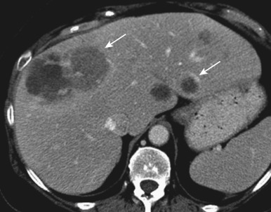 Figure 37-4, Computed tomography (CT) imaging findings of angiosarcoma. Transverse contrast-enhanced CT image during portal venous phase shows multiple round, solid masses (arrows).