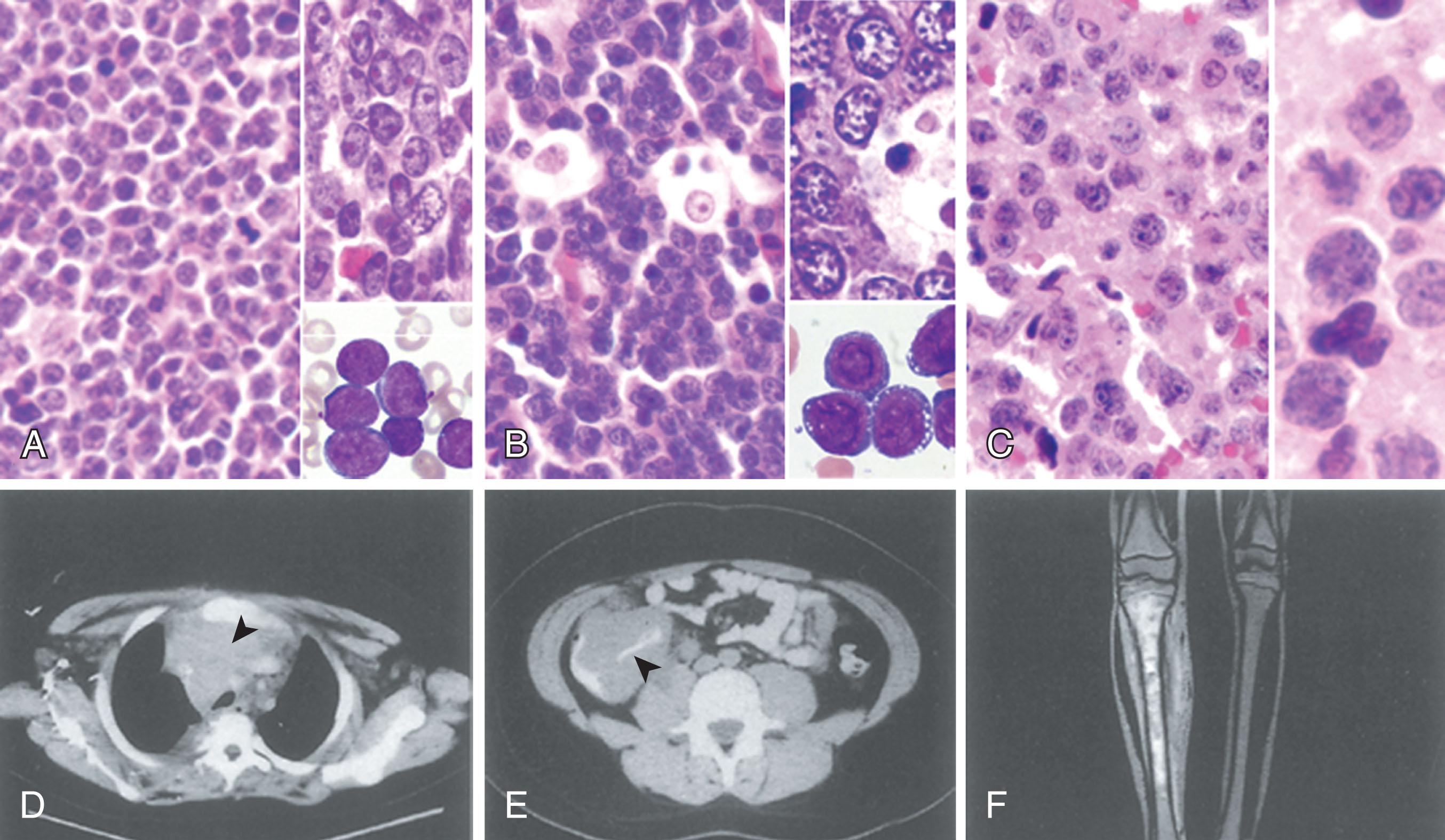 Figure 88.1, HISTOLOGIC AND CLINICAL FEATURES OF THE NON-HODGKIN LYMPHOMAS OF CHILDHOOD.