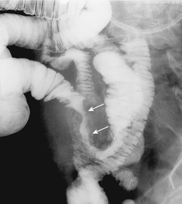 Figure 28-1, Direct invasion by bladder cancer. Intramural masses with loop fixation and mucosal tethering of an ileum segment (arrow) are causing mild small bowel obstruction.