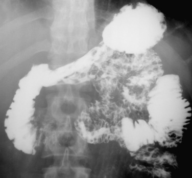 Figure 28-2, Hematogenous metastasis from malignant melanoma. Multiple nodular filling defects throughout the stomach and jejunal segments are seen on small bowel follow-through. Some of these nodules demonstrate central ulcerations.