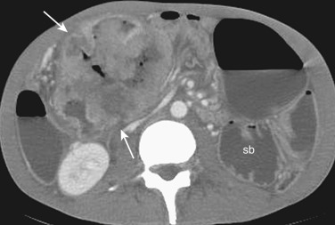 Figure 28-3, Primary colon cancer arising from hepatic flexure invading small bowel segments. Axial computed image shows large, heterogeneous mass (arrows) invading the small bowel segments in the right upper quadrant. Small bowel segments in the left upper quadrant (sb) are dilated, representing obstruction.