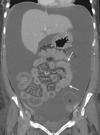 Figure 28-4, Peritoneal carcinomatosis in a patient with ovarian cancer. Coronal computed tomography image shows significant malignant ascites and diffuse wall thickening of the small bowel segments (arrows) secondary to peritoneal carcinomatosis. Additional cystic peritoneal metastatic mass (C) is seen in the left lower quadrant.