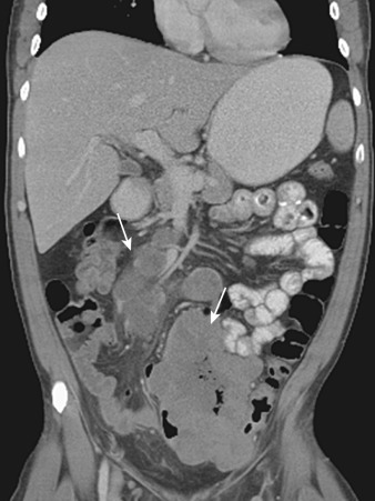 Figure 28-5, Malignant melanoma metastasis. Coronal computed tomography image shows multiple soft tissue masses in the small bowel wall and mesentery (arrows).