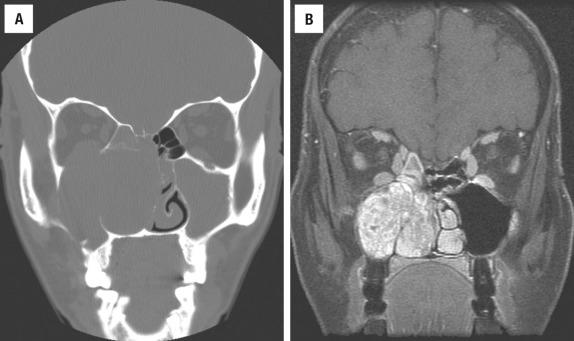 FIGURE 3.11, Sinonasal undifferentiated carcinoma. ( A ) Computed tomography scan shows a large, destructive mass within the right maxillary sinus, filling the nasal cavity and expanding into the orbit. ( B ), Magnetic resonance imaging of the same patient shows the significant extent of the tumor, highlighting the soft tissue component.