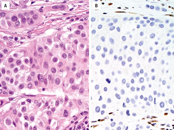 FIGURE 3.13, SMARCB1 (INI-1)-deficient sinonasal carcinoma consists of nests of undifferentiated cells with variably rhabdoid features ( A ) and is defined by an absence of SMARCB1 (INI-1) immunolabeling ( B ). Note that the normal stromal cells have retained SMARCB1 (INI-1) expression.