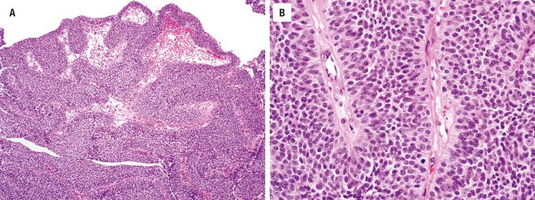 FIGURE 3.2, ( A ) Sinonasal nonkeratinizing squamous cell carcinoma consists of anastomosing ribbons of squamoid cells invading the stroma with a pushing edge. The surface demonstrates papillary features. ( B ) Nonkeratinizing primitive squamoid cells with nuclear atypia, numerous mitotic figures, and peripheral palisading of tumor nuclei. The stromal interface is smooth, and there is no desmoplasia.