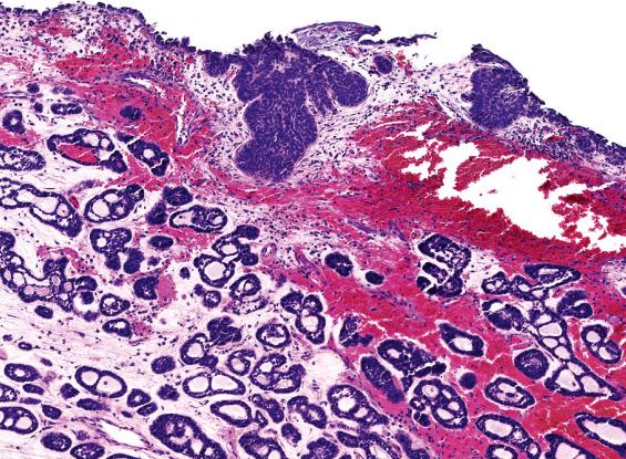 FIGURE 3.3, HPV-related multiphenotypic sinonasal sinonasal carcinoma closely resembles adenoid cystic carcinoma as it invades as cribriform structures (bottom) ; but unlike a true adenoid cystic carcinoma, it also often shows squamous dysplasia of the surface epithelium (top) .