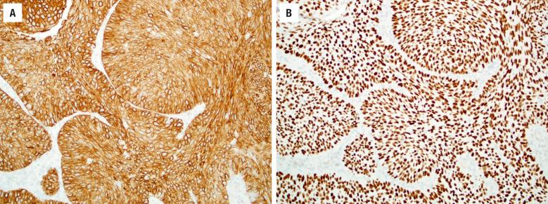 FIGURE 3.4, Sinonasal squamous cell carcinomas are diffusely positive for CK5/6 ( A ) and p40 ( B ).These findings are helpful in the differential of other basaloid sinonasal neoplasms.