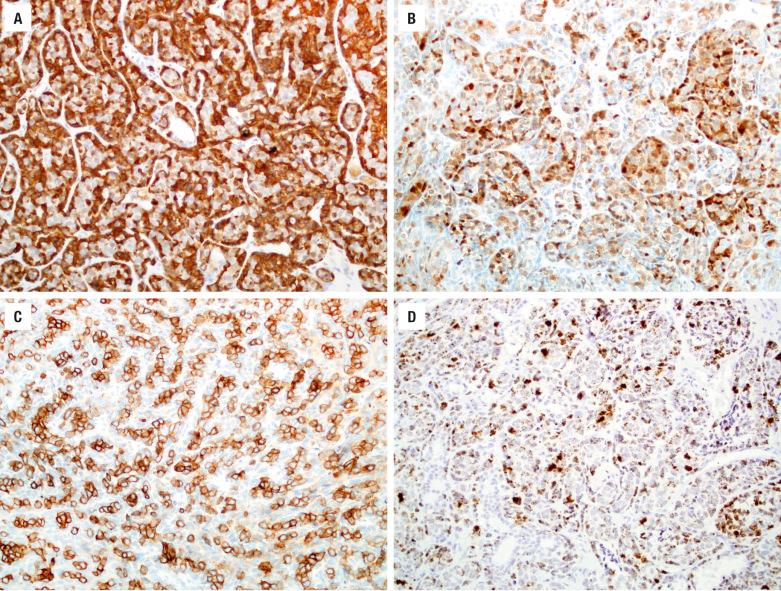 FIGURE 3.6, HPV-related multiphenotypic sinonasal carcinoma shows biphasic differentiation, with abluminal immunoreactivity for calponin ( A ) and S100 ( B ), while c-kit immunostaining highlights the luminal tumor component ( C ). ( D ), HPV33 RNA in situ hybridization is strongly positive in both tumor components.