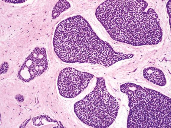 FIGURE 3.7, The solid variant of adenoid cystic carcinoma consists of solid nests of hyperchromatic cells with angulated nuclei (right) in addition to foci of more conventional-appearing, cribriform structures (left) .