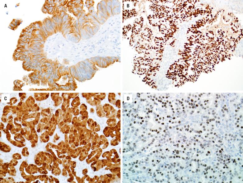 FIGURE 3.10, Intestinal-type adenocarcinomas are positive for CK20 ( A ) and SATB2 ( B ) in addition to CDX2 and villin (not pictured). Nonintestinal low-grade adenocarcinoma is usually positive for S100 protein ( C ), and often SOX10 ( D ).