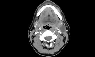 FIGURE 22.1, A computed tomography scan demonstrates typical findings for metastatic squamous cell carcinoma to neck. There is a well-defined mass deep to the sternocleidomastoid muscle in the left neck, with a thick capsule. In addition, the primary mass in the oropharynx is present, which creates asymmetry.