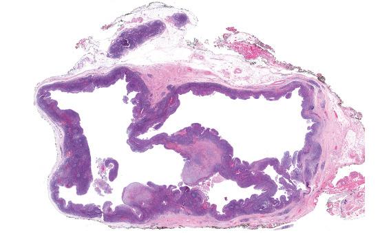 FIGURE 22.2, There is a thickened capsule at the periphery of this lymph node that is replaced by metastatic squamous cell carcinoma. The cystic metastasis shows a thin ribbon of malignant epithelial cells around the periphery. Note a smaller uninvolved lymph node at the top of the field.