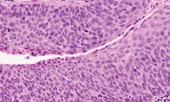 FIGURE 22.4, Atypia of human papillomavirus–associated squamous cell carcinoma can be subtle. Note the loss of polarity and disorganization, increased mitotic figures, and overall mild nuclear pleomorphism.