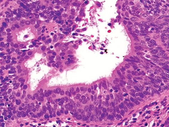 FIGURE 22.5, Rare examples of human papillomavirus–related squamous cell carcinomas are ciliated. Although this feature may cause confusion for a benign cyst, the carcinoma still exhibits significant cellular atypia.