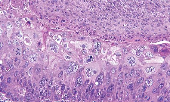 FIGURE 22.6, Metastatic squamous cell carcinoma can show focally severe pleomorphism.