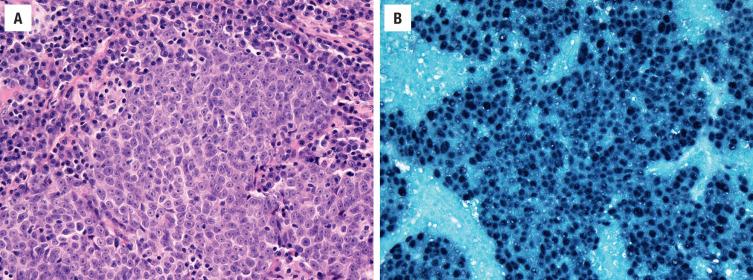 FIGURE 22.7, ( A ) Nasopharyngeal carcinoma can appear as an undifferentiated carcinoma. Diagnosis can be confirmed by in situ hybridization for Epstein-Barr virus ( B ).