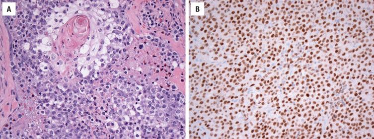 FIGURE 22.8, ( A ) NUT carcinoma shows foci of abrupt keratinization within an otherwise monotonous population of undifferentiated-appearing epithelioid cells. ( B ) NUT immunohistochemistry shows a positive punctate nuclear staining pattern.