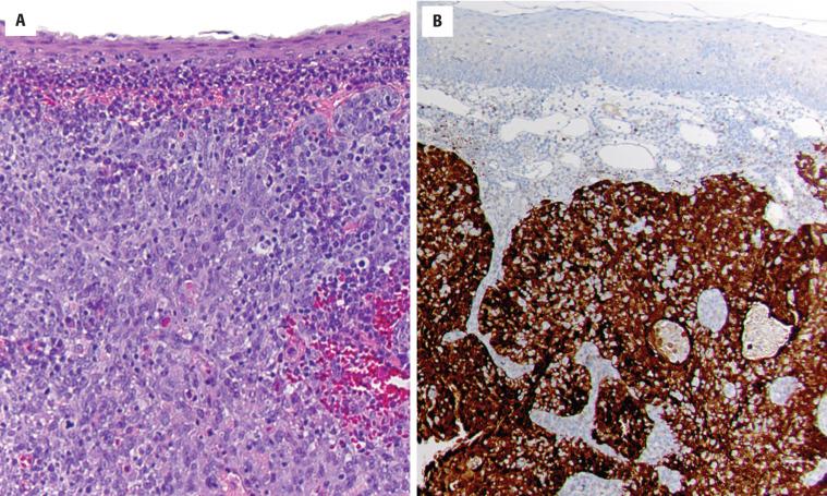 FIGURE 22.9, ( A ) Human papillomavirus (HPV)-associated squamous cell carcinoma from a tonsillar primary shows a typical nonkeratinizing morphology. ( B ) Strong, diffuse, nuclear and cytoplasmic p16 immunoreactivity is a surrogate marker for high-risk HPV.