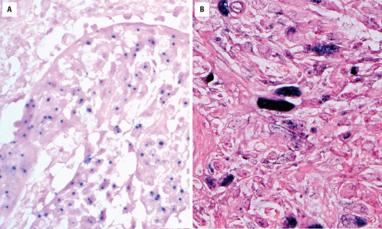 FIGURE 22.10, In situ hybridization for high-risk human papillomavirus in a metastatic oropharyngeal squamous cell carcinoma. ( A ) Integrated virus showing a punctate staining pattern. ( B ) Episomal virus showing diffuse nuclear staining.