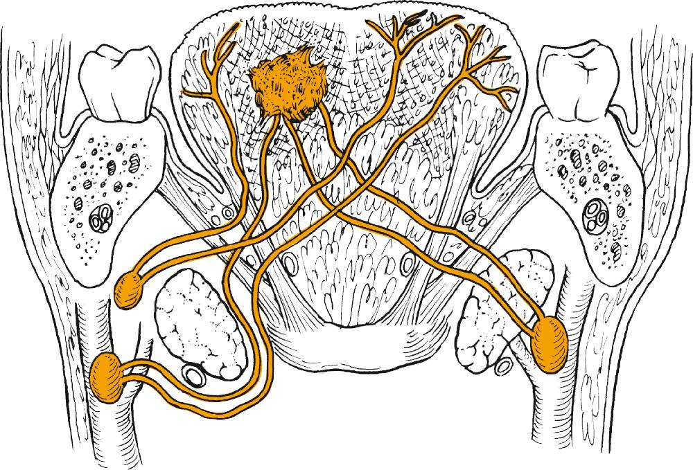 Fig. 96.6, Bilateral base of the tongue lymphatic drainage.