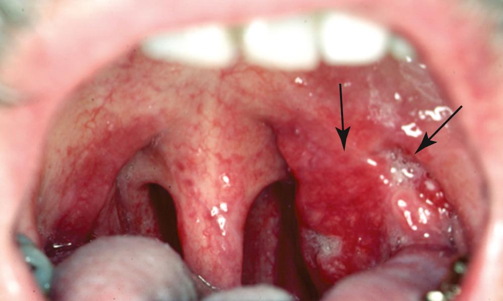 Fig. 96.7, Squamous cell carcinoma of the left tonsil (arrows) .