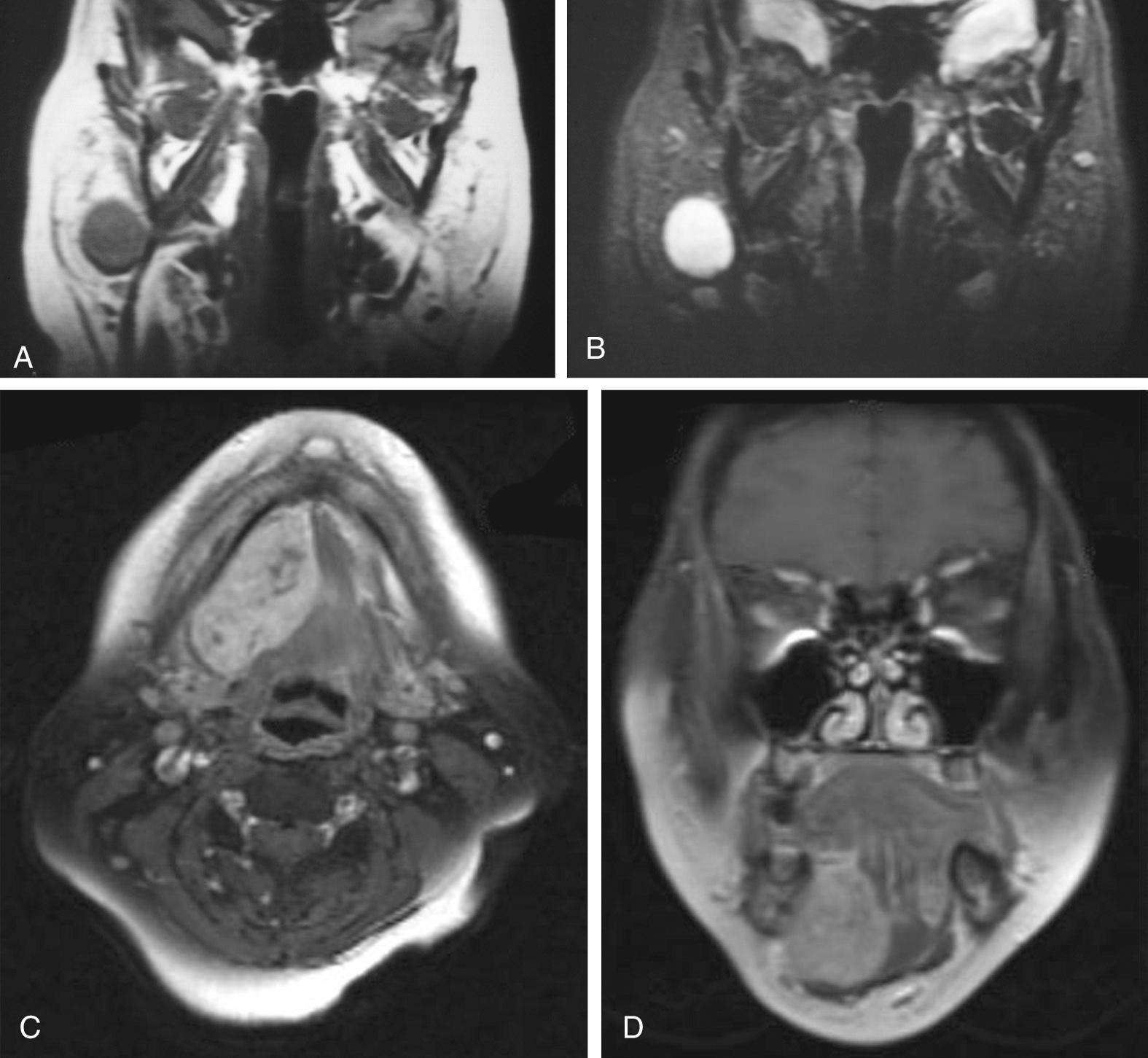 Fig. 85.1, Magnetic resonance imaging of salivary gland neoplasms.