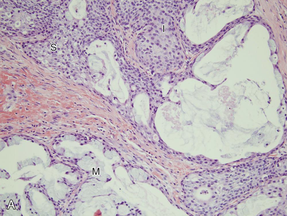 Fig. 85.3, Mucoepidermoid carcinoma.