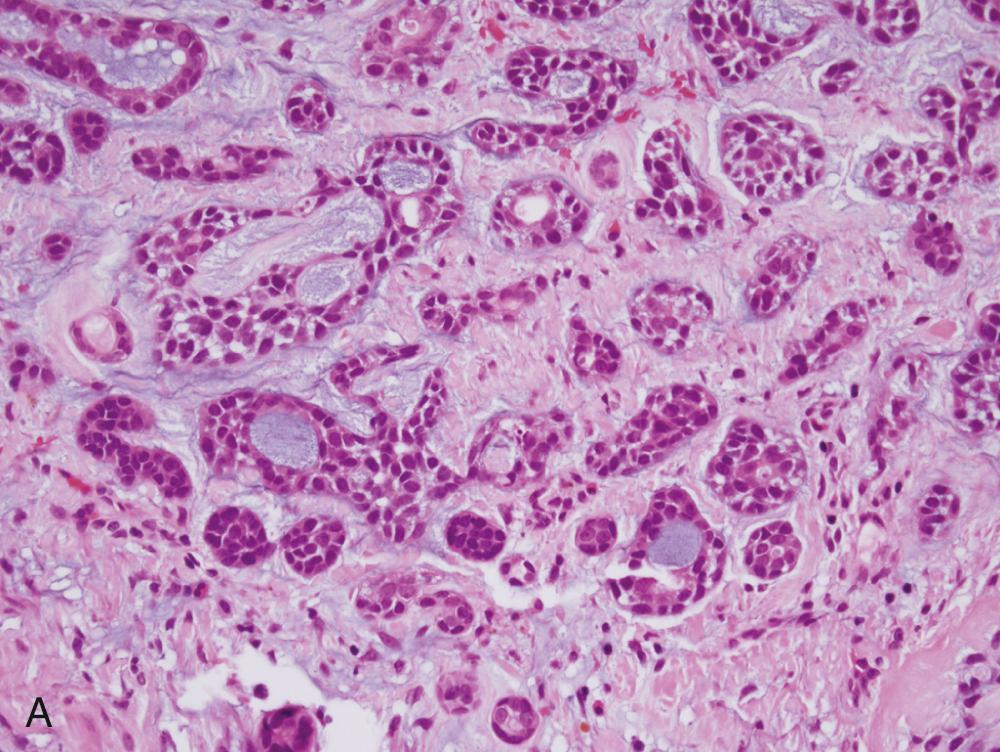 Fig. 85.4, Adenoid cystic carcinoma.