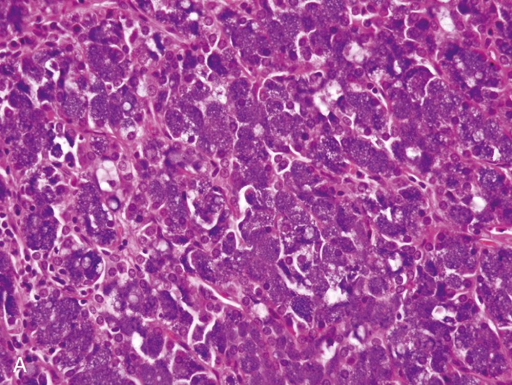 Fig. 85.6, Acinic cell carcinoma.