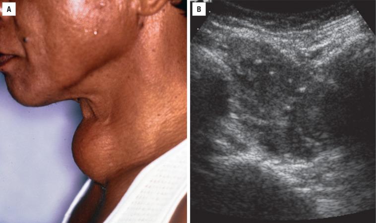 FIGURE 25.1, ( A ) A clinical photograph shows a large, protuberant mass at the level of the thyroid gland. ( B ) An irregular mass within the thyroid with mixed echogenicity by ultrasound, showing punctate calcifications, characteristic for a papillary carcinoma.