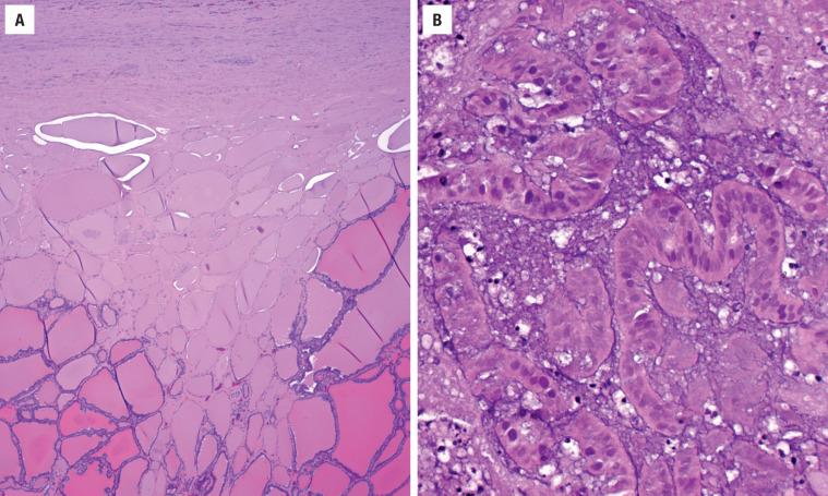 FIGURE 25.11, ( A ) “Mummification” of the cells, at the periphery of the tumor, creating a wedge shape is an uncommon, but unique feature of papillary carcinoma. ( B ) Tumor infarction results in ghost cell outlines, still showing papillae, but no longer viable tumor cells.