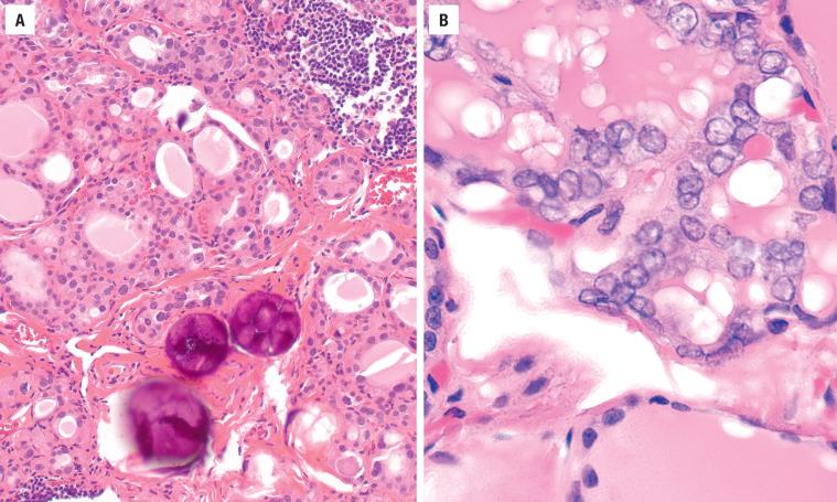 FIGURE 25.12, ( A ) Psammoma bodies are noted in this case of diffuse hyperplasia, with a microscopic papillary thyroid carcinoma noted elsewhere in the lobe. ( B ) Papillary carcinoma within a lymphatic unassociated with any fibrosis. Benign thyroid parenchyma is noted in the lower portion of the figure.