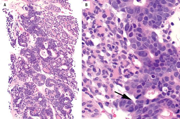 FIGURE 25.13, ( A ) Poorly differentiated carcinoma is considered in the presence of increased mitoses, necrosis, and high cellularity. ( B ) Note there are three mitoses in just this one high power field ( arrow ).