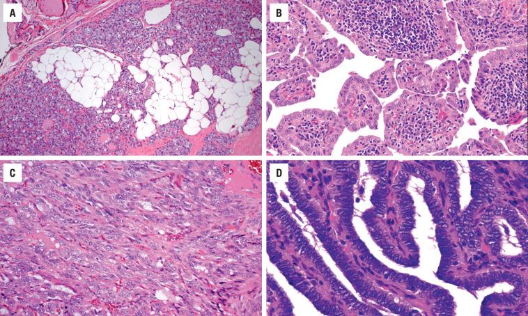 FIGURE 25.14, Uncommon features in PTC. ( A ) Fatty metaplasia. ( B ) Lymphocytes and plasma cells, sometimes referred to as “Warthin” variant of papillary carcinoma. ( C ) Tumor cell spindling. ( D ) No colloid is seen in this tumor with marked nuclear overlapping and stratification.