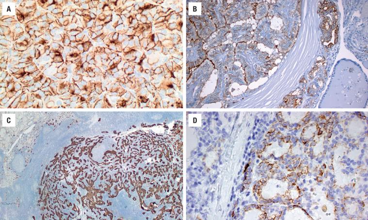 FIGURE 25.15, HMBE-1. Note the variable membrane and cytoplasmic expression in the tumor cells (heavy in A ), including an area of invasion ( B ). CK19. There is strong cytoplasmic reactivity ( C ), while in other areas it is only delicate, partial membranous staining ( D ).