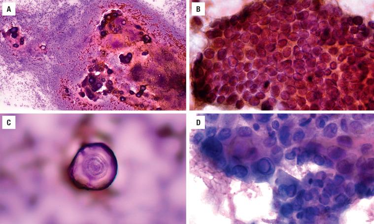 FIGURE 25.16, ( A ) Three-dimensional clusters in a cellular smear with psammoma bodies noted (Diff-Quik). ( B ) A syncytium of cells with enlarged nuclei and nuclear grooves (alcohol fixed, Papanicolaou stain). ( C ) A psammoma body is characteristic of papillary carcinoma (Diff-Quik). ( D ) Three-dimensional papillae around a central fibrovascular core showing nuclei with intranuclear cytoplasmic inclusions (air dried, Diff-Quik stain).