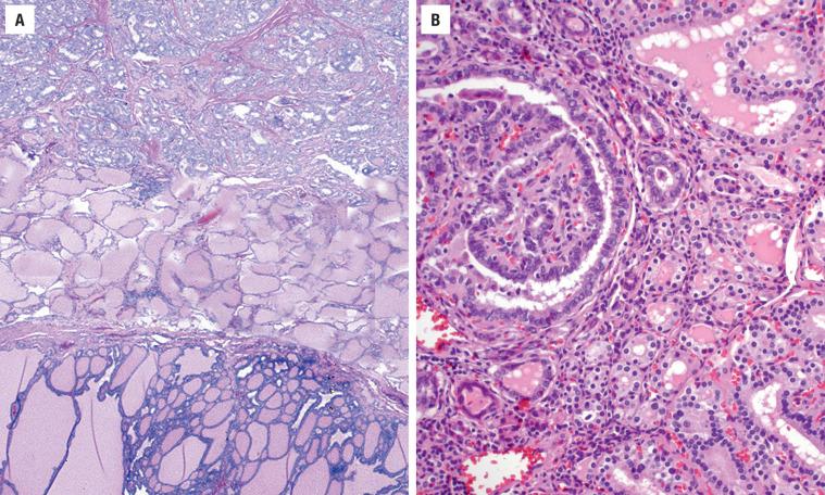 FIGURE 25.17, ( A ) Adenomatoid nodule ( lower half ) and papillary carcinoma ( upper half ) frequently co-exist. There are differences in architecture and cytology, even at this low magnification. ( B ) A papillary carcinoma ( right upper ) has a completely different appearance than the background of diffuse hyperplasia.