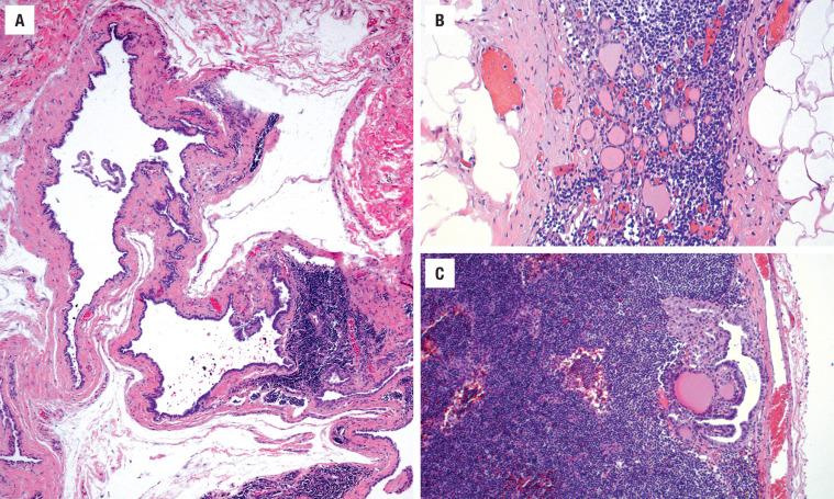 FIGURE 25.19, ( A ) A predominantly cystic metastasis can sometimes simulate a lymphangioma or branchial cyst. ( B ) Almost “normal” appearing follicles within a lymph node. However, this represented metastatic disease from an ipsilateral primary papillary carcinoma. ( C ) Papillary projections and colloid of metastatic papillary carcinoma in a lymph node.