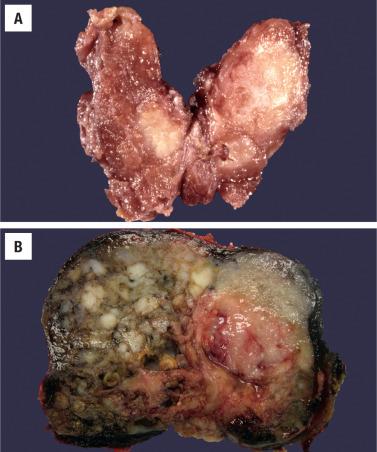 FIGURE 25.2, ( A ) Three separate primaries are noted, with the largest lesion in the left upper lobe. There is an infiltrative border to these sclerotic tumors. ( B ) A large, irregular, multilobular mass nearly completely replaces the thyroid lobe. Note the areas of more fleshy tumor compared to cystic areas of degeneration. This tumor fit within the columnar variant of papillary carcinoma.