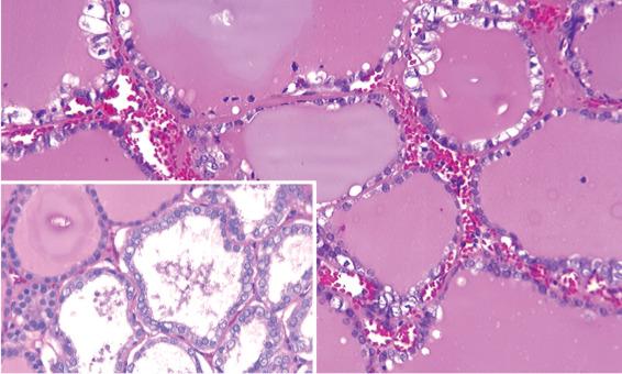 FIGURE 25.24, Large follicles are lined by flattened to atypical follicular cells with scalloped colloid in this macrofollicular variant of papillary carcinoma. Inset demonstrates an area of increased cellularity and the cytologic features of papillary carcinoma.